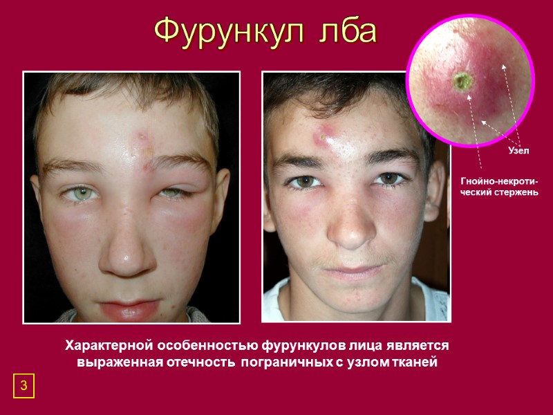 Фурункул лба Характерной особенностью фурункулов лица является выраженная отечность пограничных с узлом тканей Гнойно-некроти-